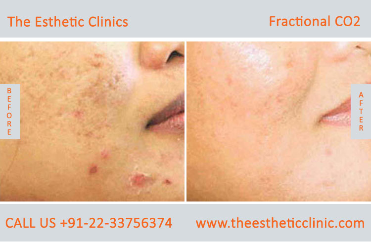 Fractional Co2 Laser Skin Resurfacing Treatment before after photos in mumbai india (1)